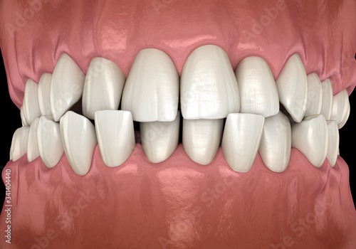 Anterior crossbite dental occlusion ( Malocclusion of teeth ). Medically accurate tooth 3D illustration photo