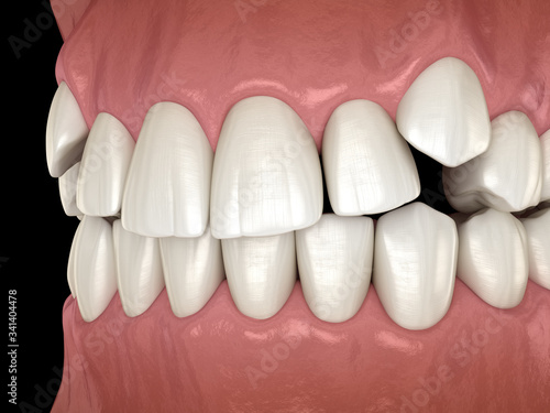 Impacted incisors, overcrowded teeth. Medically accurate 3D illustration of abnormal dental occlusion