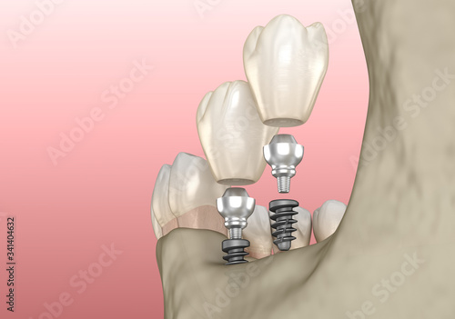 Implantation with mini implants in to recessed jaw bone: Medically accurate 3D illustration