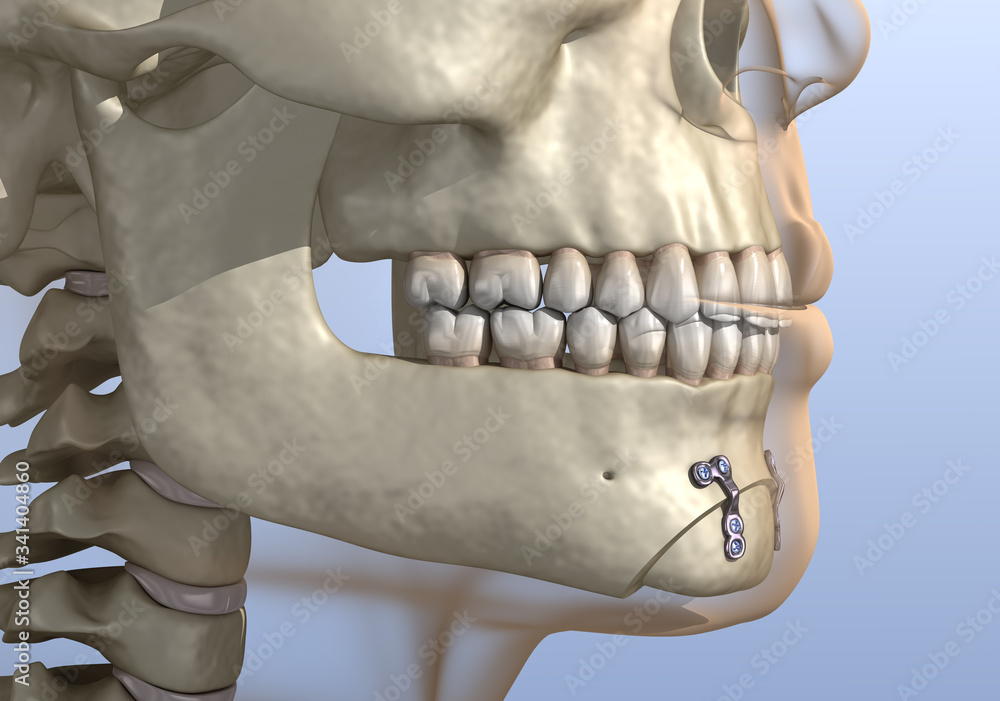 Chin Reduction (Osseous Genioplasty) surgery. Medically accurate dental ...