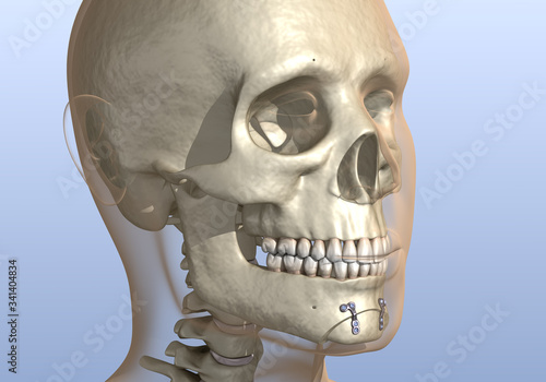 Chin Reduction (Osseous Genioplasty) surgery. Medically accurate dental 3D illustration. photo