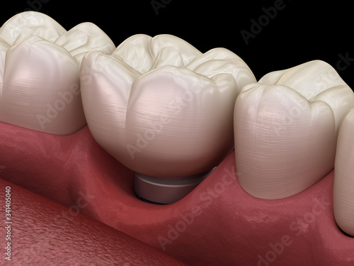 Fototapeta Naklejka Na Ścianę i Meble -  Peri-implantitis with visible gum recession. Medically accurate 3D illustration of dental implants concept