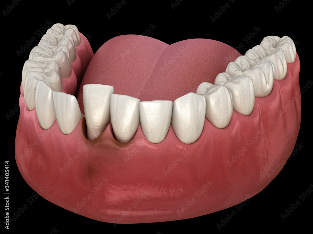 Obraz premium Tooth dislocation after trauma. Medically accurate 3D illustration