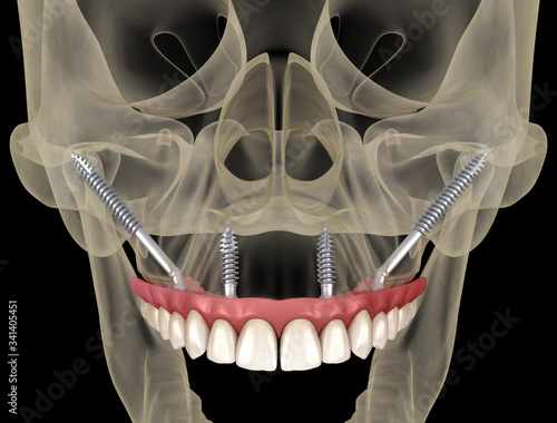 Maxillary prosthesis supported by zygomatic implants. Medically accurate 3D illustration of human teeth and dentures
