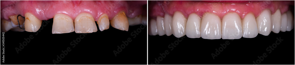 Fototapeta premium full mought recovery by press ceramic crowns and implants