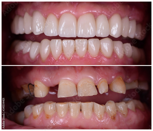 full mought recovery by press ceramic crowns and implants