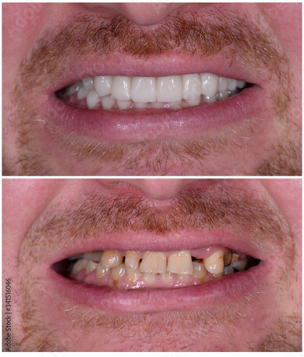 full mought recovery by press ceramic crowns and implants