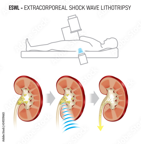 Extracorporeal shock wave lithotripsy (ESWL) for kidney stones. shock waves to break a kidney stone