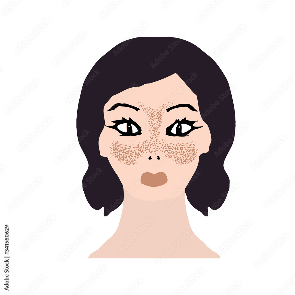 Freckles on the face. Pigmentation on the skin. A pigmented spot on the skin of the face. Before and after treatment. Vector illustration Freckles on the face. Pigmentation on the skin. A pigmented spot on the skin of the face. Before and after treatment. Vector illustration