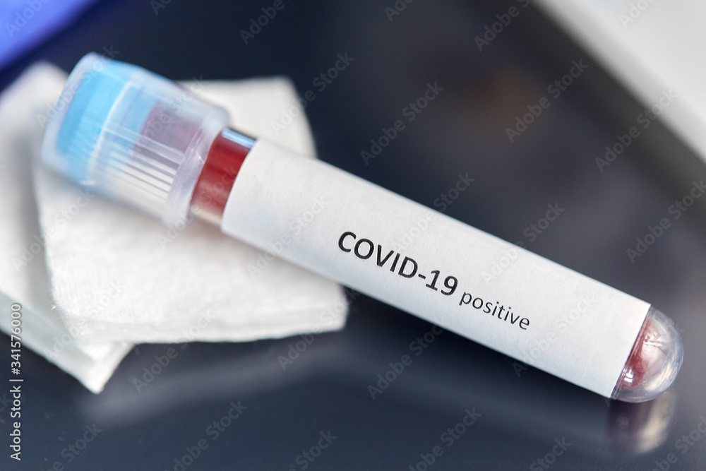 Obraz premium medicine, healthcare and pandemic concept - close up of beaker with positive coronavirus blood test on table at laboratory