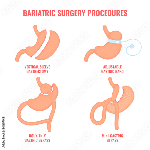 Types of bariatric surgery weight loss procedures- gastric bypass, sleeve gastrectomy, adjustable gastric band. Stomach reduction medical diagram infographic. Health care concept. Vector illustration.