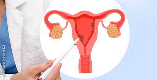 Uterine polyps, the gynecologist points to the polyps on the endometrium . non cancerous on the endometrium photo
