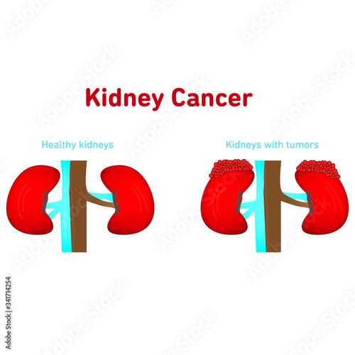 Healthy and cancerous kidney tumor