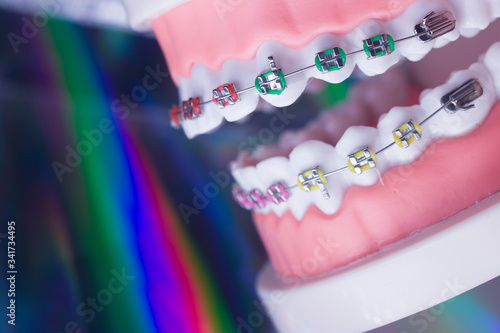 Dental brackets teeth straighteners