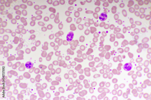 Essential thrombocytosis blood smear, present abnormal high platelet and white blood cell