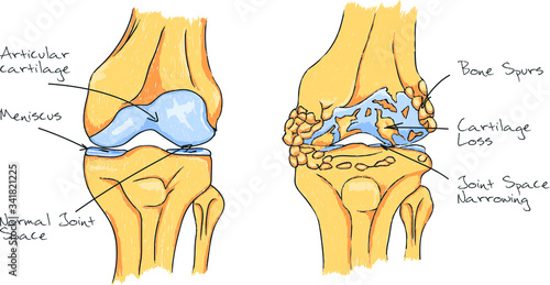 Arthritis knee. Knee Pain. Scheme