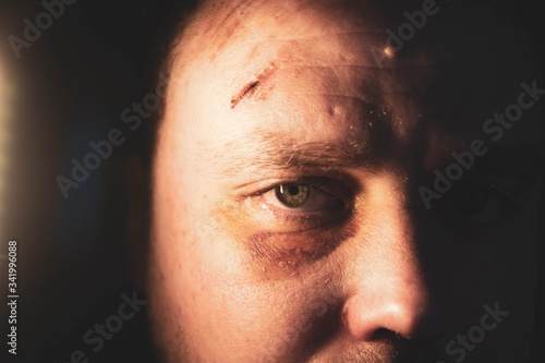 A black eye on a man after a fight. Abrasions and wounds. Attack on the street. Portrait close-up.