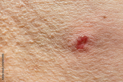 Itchy skin.Torn skin at the site of inflammation. Peeling and combing of the skin with various skin diseases. Prurigo. Pruritus. photo