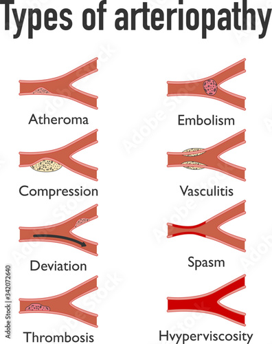 Types of arteriopathy, set of arteries atheroma, embolism, compression, vasculitis, deviation, spasm, thrombosis, hyperviscosity medicine icons. vector eps 10