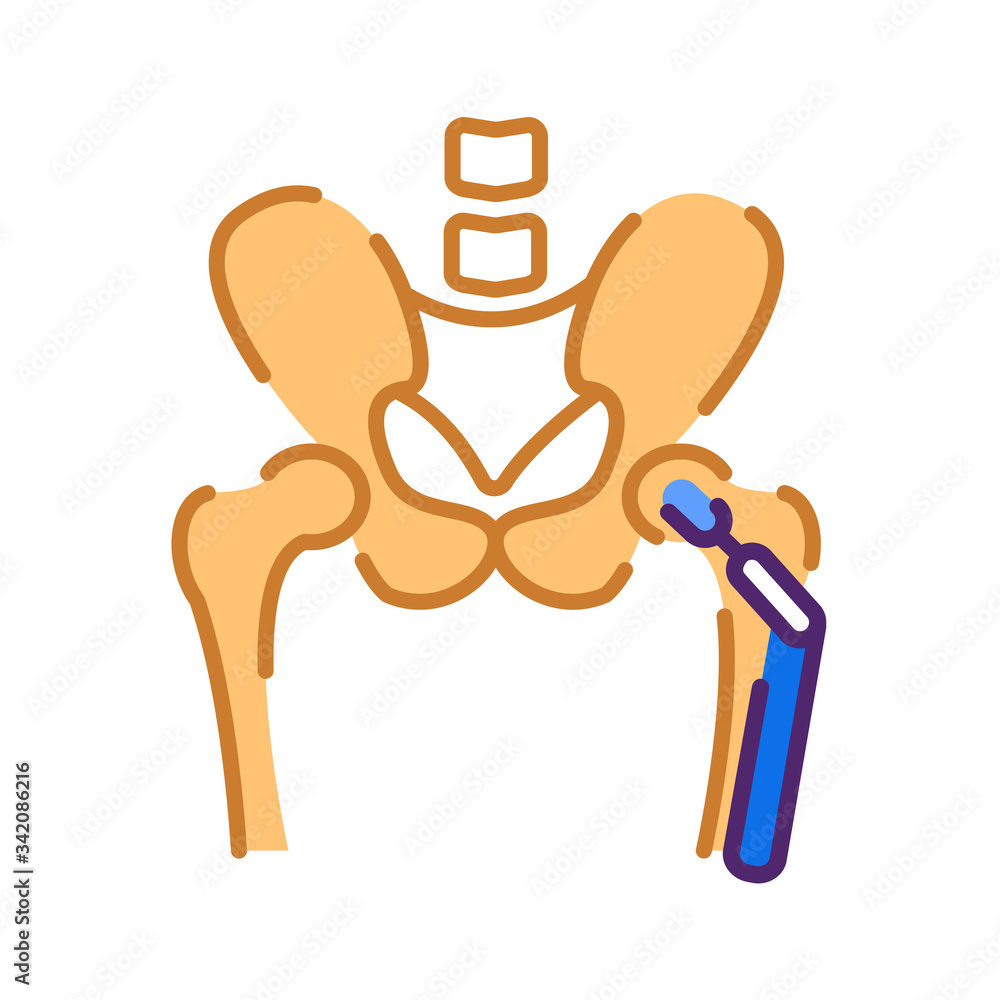 Arthroplasty flat color icon. Hip replacement implant installed in the ...
