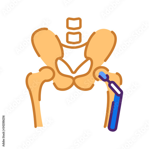 Arthroplasty flat color icon. Hip replacement implant installed in the pelvis bone. Sign for web page, mobile app, button, logo. Vector isolated button