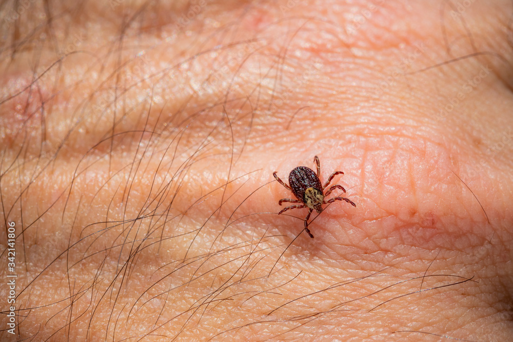 Mite tick. A tipical summer parasite in Europe. May cause several dangerouse infections and illness like erlechiosis, encephalitis, potomac fever and others Mite tick. A tipical summer parasite in Europe. May cause several dangerouse infections and illness like erlechiosis, encephalitis, potomac fever and others