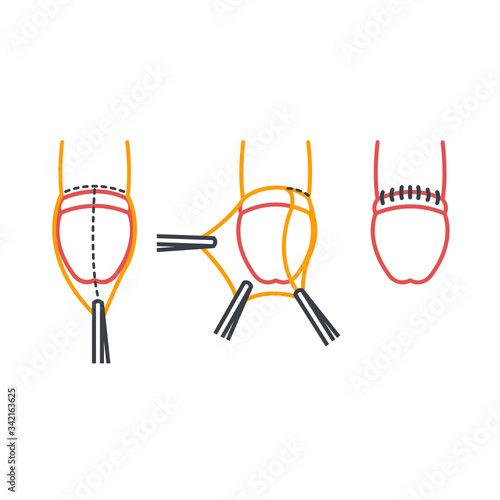 circumcision line icon, vector illustration