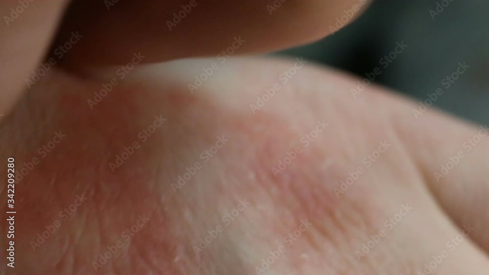 Severe itching, allergic reaction, fungal infection, scabies. The affected skin has red spots, irritation, papules, peeling, eczema. Extreme close-up, real time, contains people. Severe itching, allergic reaction, fungal infection, scabies. The affected skin has red spots, irritation, papules, peeling, eczema. Extreme close-up, real time, contains people.