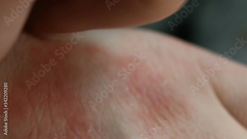 Severe itching, allergic reaction, fungal infection, scabies. The affected skin has red spots, irritation, papules, peeling, eczema. Extreme close-up, real time, contains people. photo