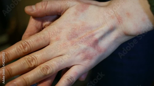 This Is Haphephobia. Allergic to human touch. From stress. Touch of human many years ago caused a recurring reaction. it's true. Plus a secondary fungal infection. photo
