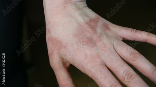 Psychosomatic Allergy to a man's touch (possibly sweat). Perhaps a skin reaction to childhood abuse. photo