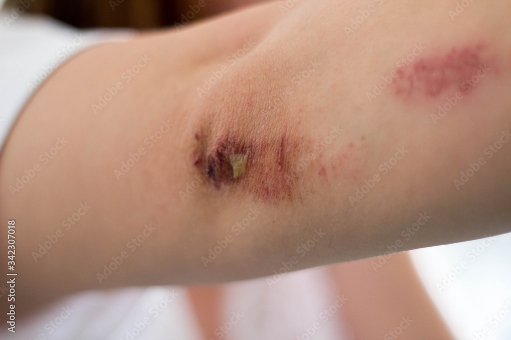 Close-up of a scar hypertrophic scar on the elbow received when falling Close-up of a scar hypertrophic scar on the elbow received when falling