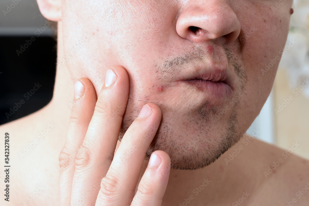 dermatological problems with skin on the face of a man. dermatological problems with skin on the face of a man.