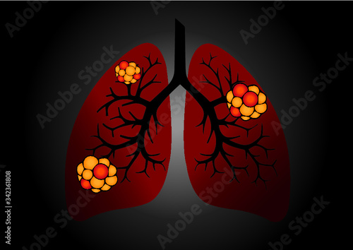 Comparison between healthy lung and cancer lung isolated on white background. Healthy lung and 
Pneumonia. Lung was infected by pathogen 