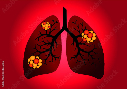 Comparison between healthy lung and cancer lung isolated on white background. Healthy lung and 
Pneumonia. Lung was infected by pathogen 