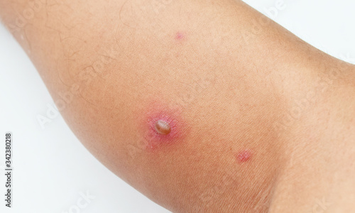 Injured skin - burning skin, blistered skin, wounded skin from insect bites