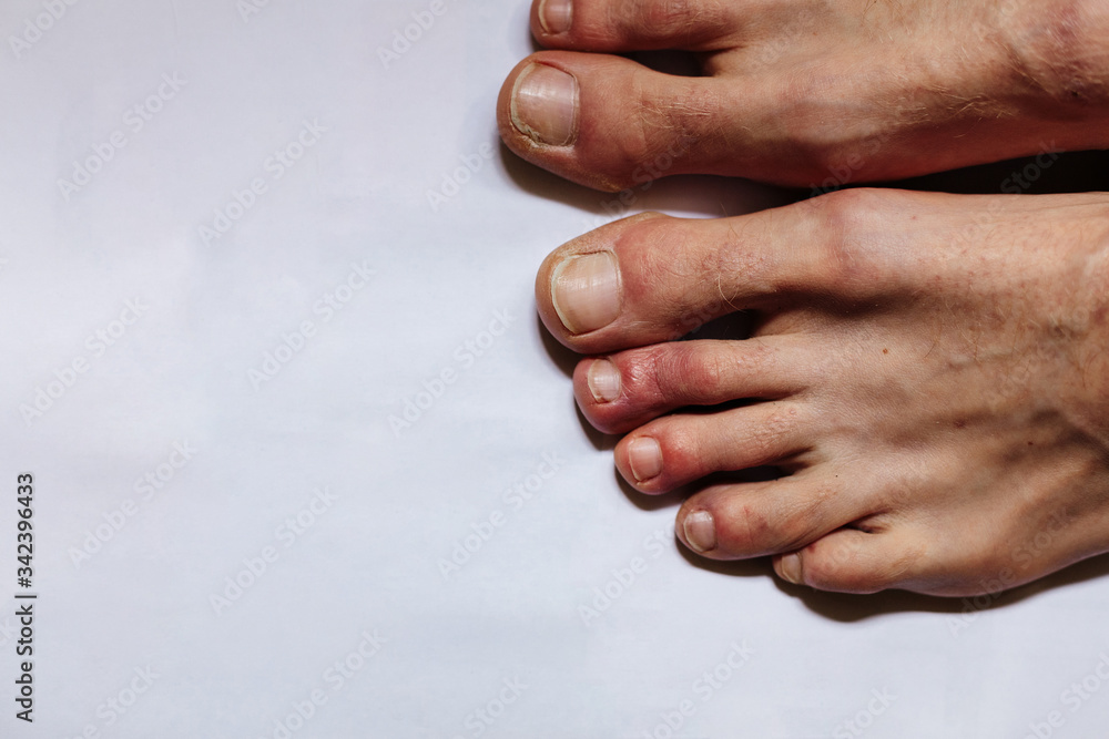 Purple Toes Symptom
