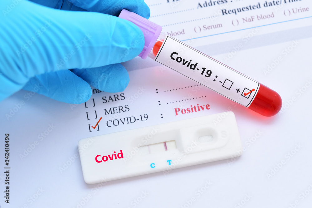 Positive test result by using rapid test device for COVID-19 virus Positive test result by using rapid test device for COVID-19 virus