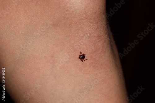 A small tick on a child’s leg. Dangerous insect, the carrier of many diseases.