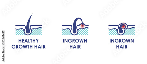Healthy growth hair. Ingrown hair. Vector icons