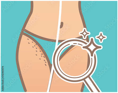 Intimate hygiene. Bikini shaving. Hair growth. Hair removal illustration