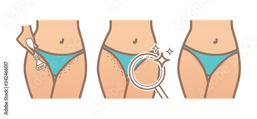 Intimate hygiene. Bikini shaving. Hair growth. Hair removal