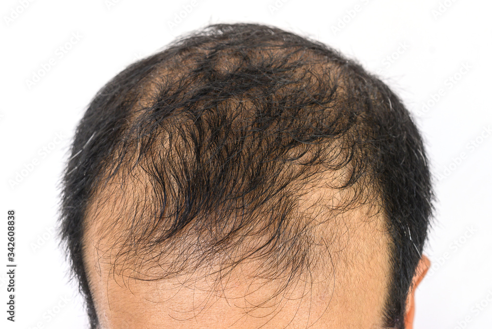 Close up of Male-pattern baldness typically appears first at the hairline or top of the head. It can progress to partial or complete baldness. Close up of Male-pattern baldness typically appears first at the hairline or top of the head. It can progress to partial or complete baldness.