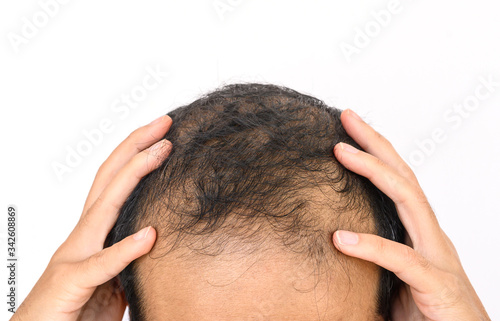 Close up of Male-pattern baldness with white copy-space, typically appears first at the hairline or top of the head. It can progress to partial or complete baldness.