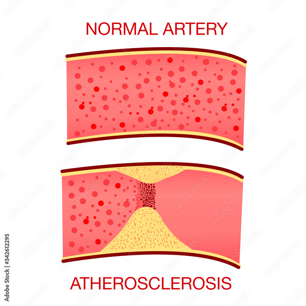 Normal artery. The accumulation of cholesterol in the blood vessels ...