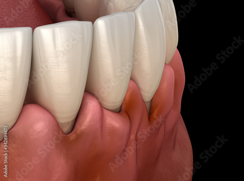Gingivitis inflammation of the gums. Medically accurate 3D illustration photo