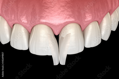 Diastema treatment  Micro veneer installation procedure over central incisor. Medically accurate tooth 3D illustration