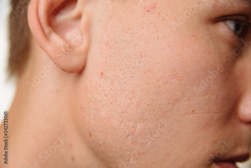 Acne scars on the face