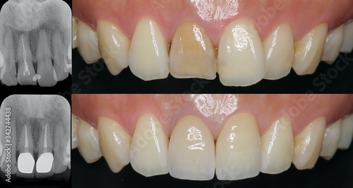 前歯　審美歯科　セラミック治療