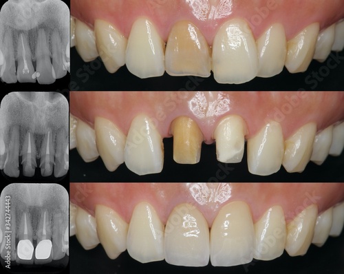 前歯　審美歯科治療